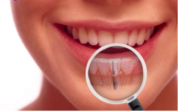 Dental Implants